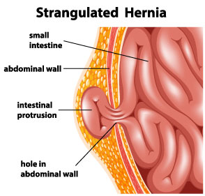Hernia illustration