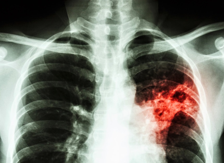 Tuberculosis